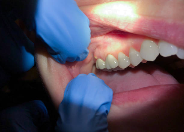 Best Tooth Infection Emergency Dentist  in San Felipe Pueblo, NM