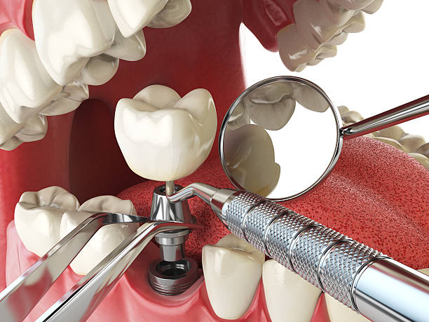 Best Root Canal Emergency Dentist  in San Felipe Pueblo, NM